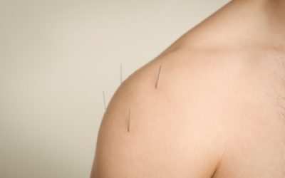 3 Undeniable Health Benefits of Dry Needling