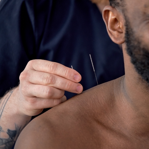 Acupuncture-Centre-Street-Physiotherapy-and-Wellness-Clinic-Calgary-AB