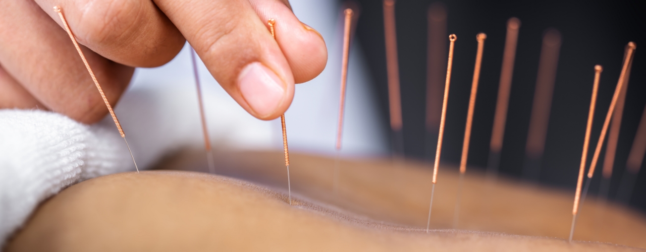 Acupuncture-Centre-Street-Physiotherapy-and-Wellness-Clinic-Calgary-AB